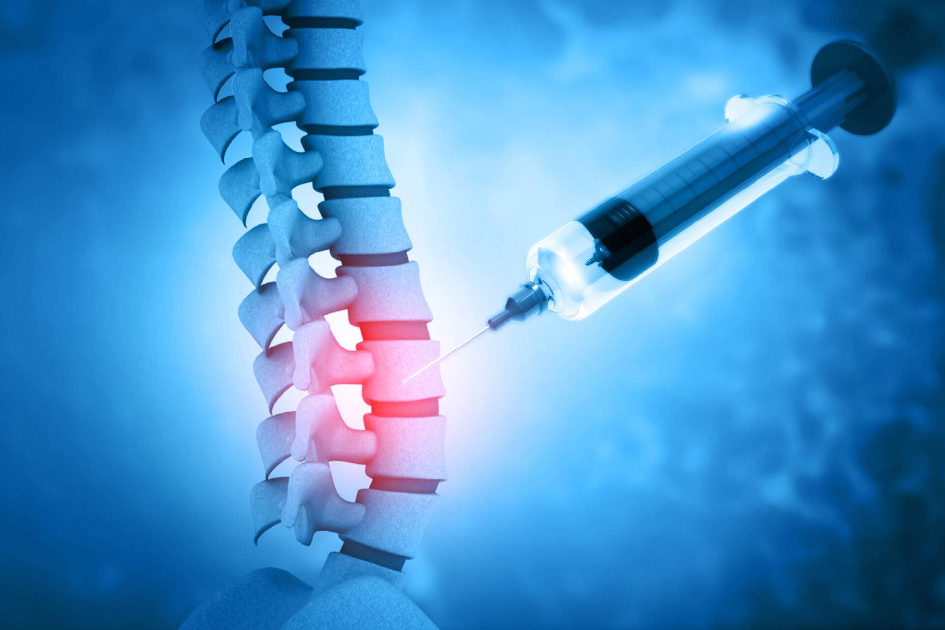 Types Of Spinal Injections For Back Pain